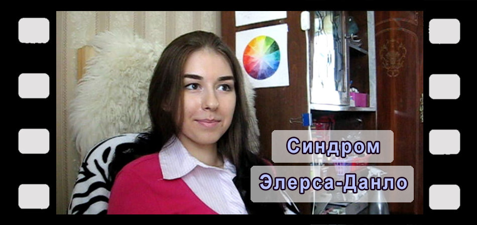 Синдром Элерса-Данло: видео