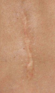 skin-scar-EDS