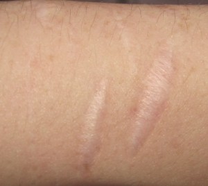 skin-scar-EDS2